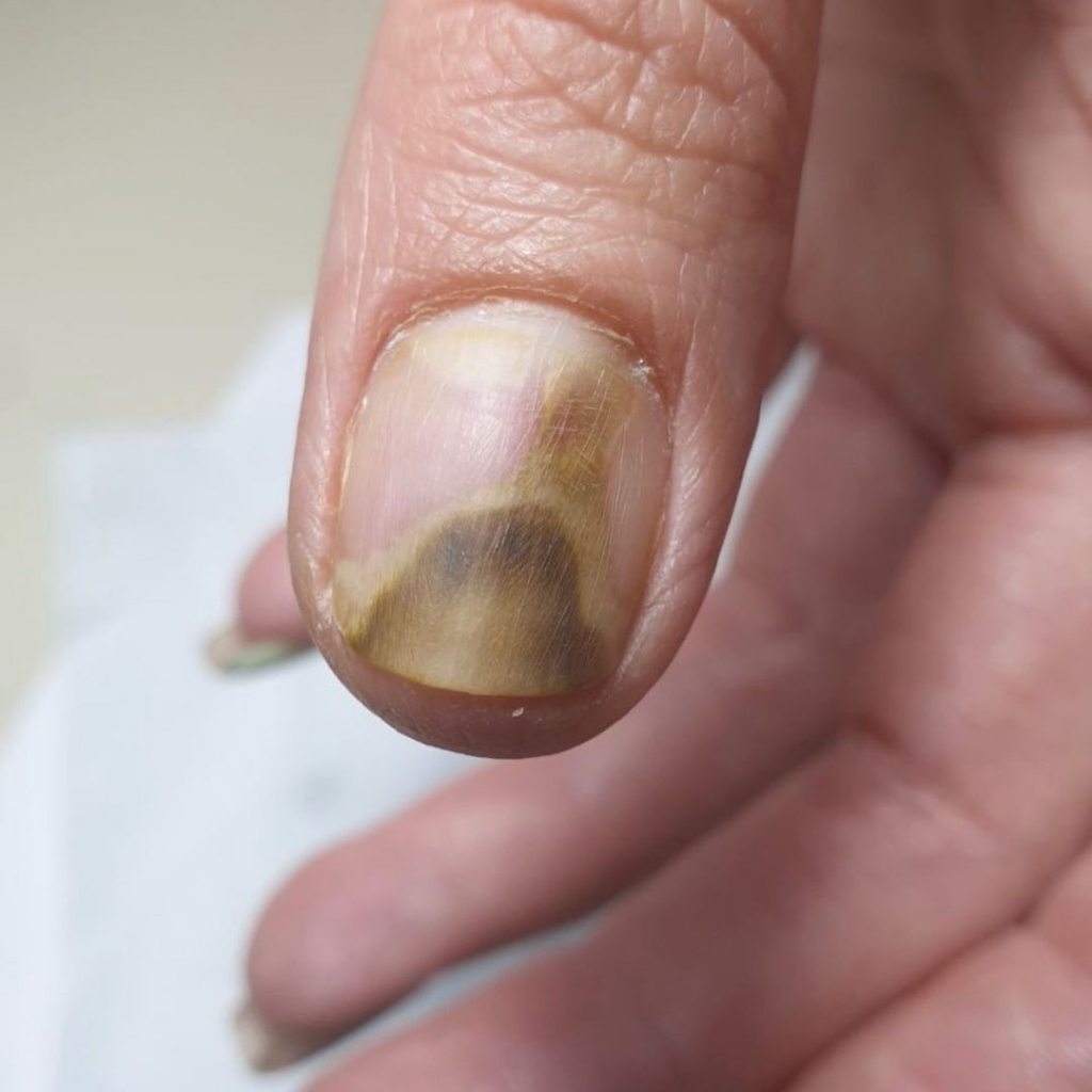 Почему у женщин синеют ногти на руках: причины и способы предотвращения