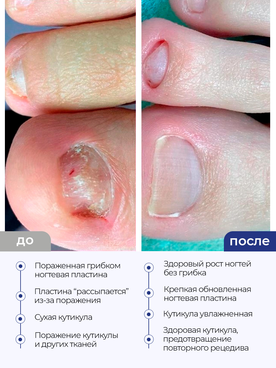 Дизайн ногтей. Товар: Rosilak, ENZYME размягчающая гель-сыворотка для ногтей и кожи, 25 мл