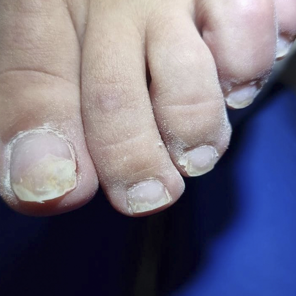 Онихолизис – это дефект натуральной ногтевой пластины.jpg