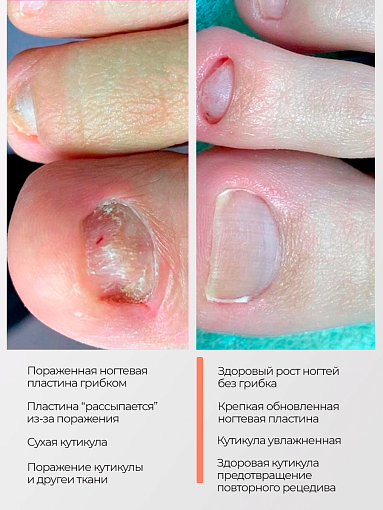 Rosilak, набор №18 гель-сыворотка для ногтей и кожи и регенератор от онихолизиса (2 шт по 10 мл)