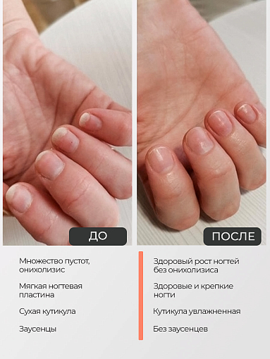 Rosilak, регенератор от онихолизиса, 25 мл