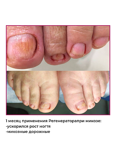 УЦЕНКА, Rosilak, REGENERATOR - средство от аллергического дерматита и онихолизиса, 25 мл