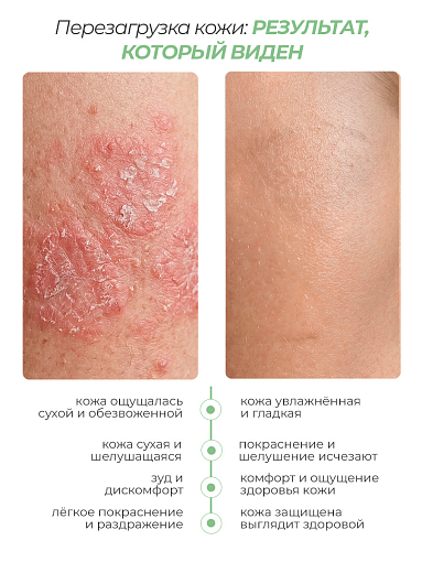 Rosilak, Ekzomikoz - крем для тела против грибка от зуда и раздражения, 50 мл