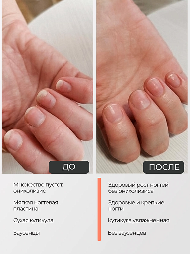 Rosilak, набор №18 гель-сыворотка для ногтей и кожи и регенератор от онихолизиса (2 шт по 10 мл)