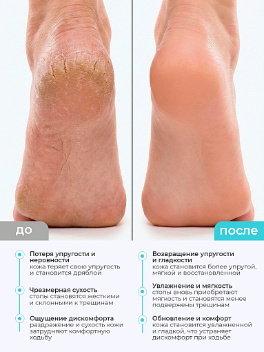TNL, набор №261 пенка-кератолитик с мочевиной для стоп и крем-воск для пяток 3в1 от трещин и сухости