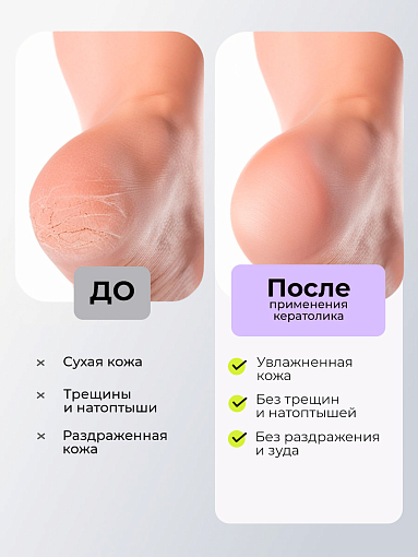 ФармКосметик / Livsi, Cerato Gel - кератогель от среднего кератоза, 100 мл